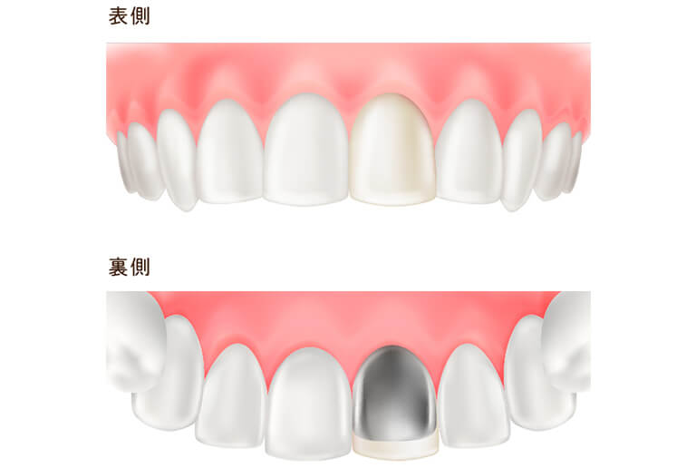 硬質レジン前装冠