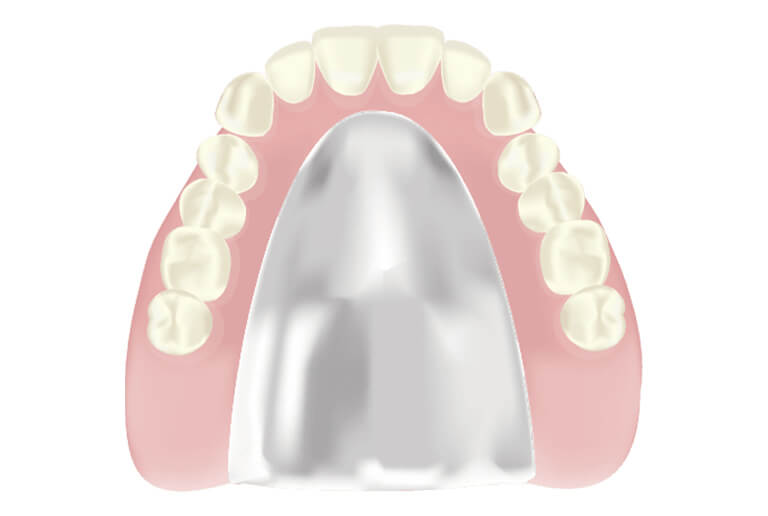 コバルトクロム床義歯