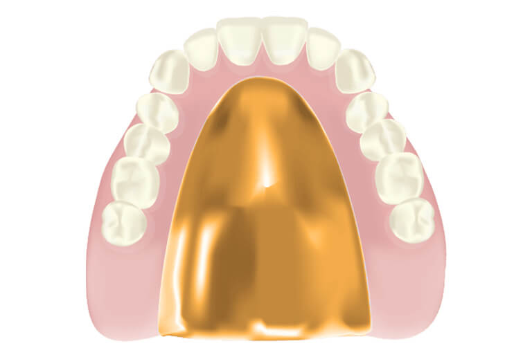 ゴールド床義歯