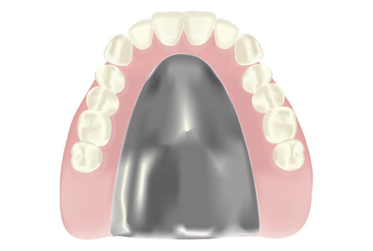 チタン床義歯